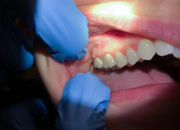 Best Same-Day Emergency Dental Services in Lyndhurst, VA